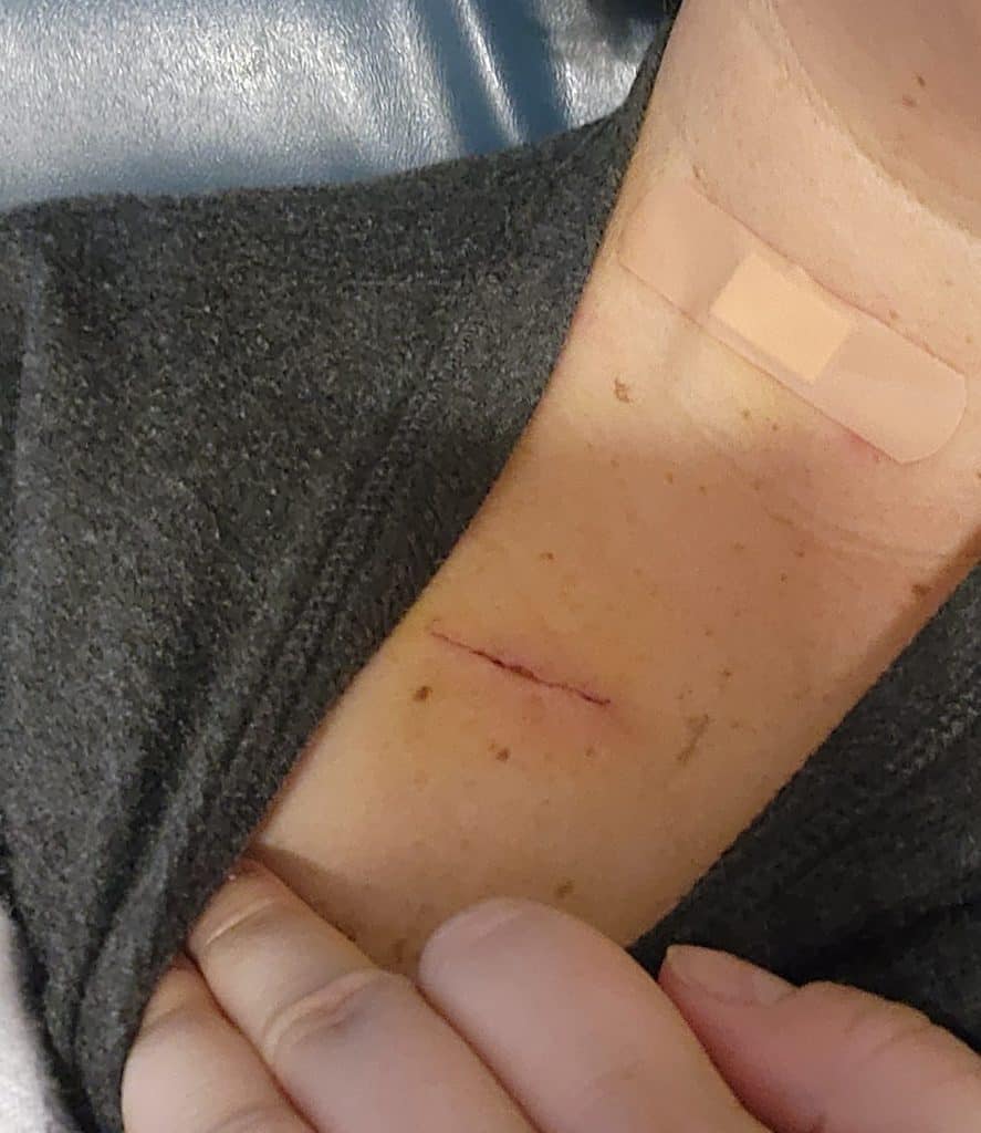 A close-up of an arm with a healing cut covered with an adhesive bandage after a successful surgery.